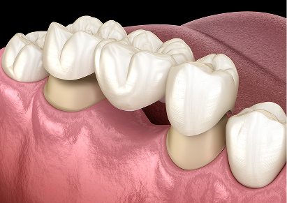 Dental Bridges