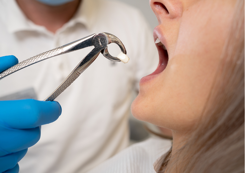 Tooth Extractions