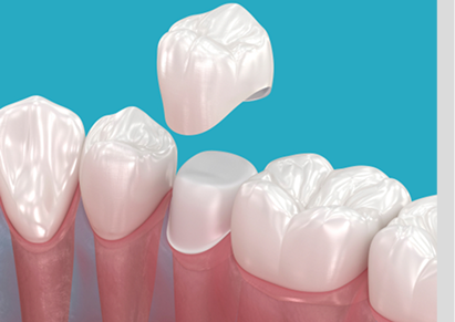 Ceramic Crowns