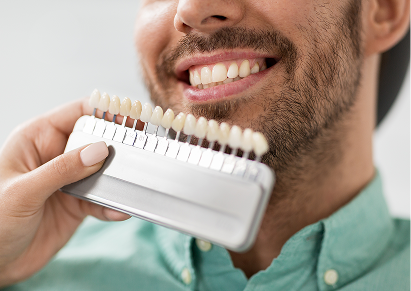 Traditional Veneers