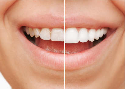 Veneers