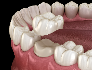 Dental Crowns