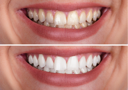 In-Office Whitening