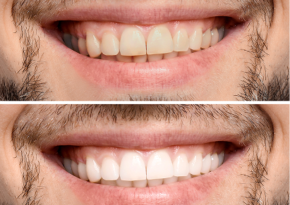 At-Home Whitening