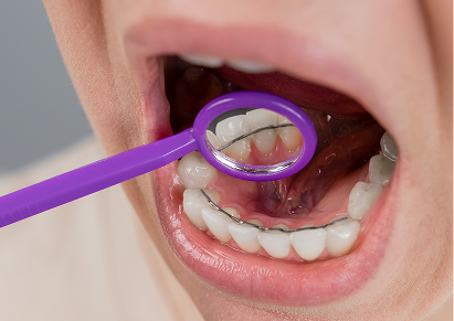 Fixed Retainers