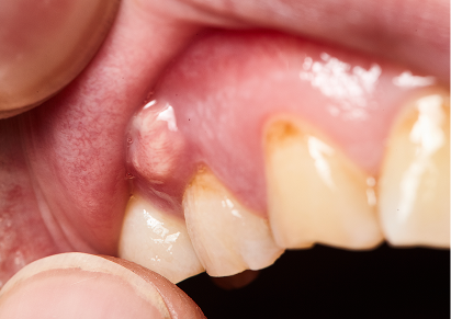 Abscessed Teeth