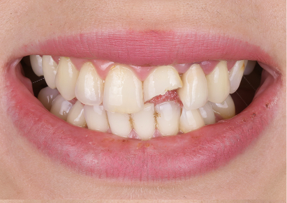 Broken or Chipped Teeth