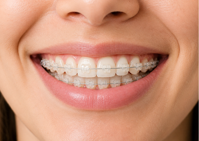 Damon™ Braces