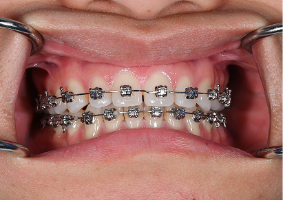 Traditional Braces