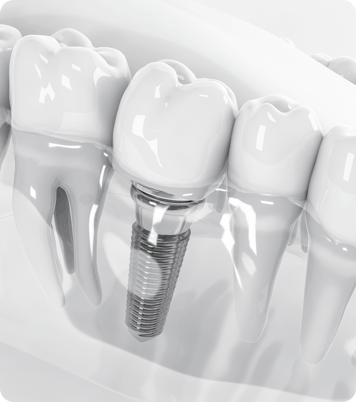 Single Tooth Replacement