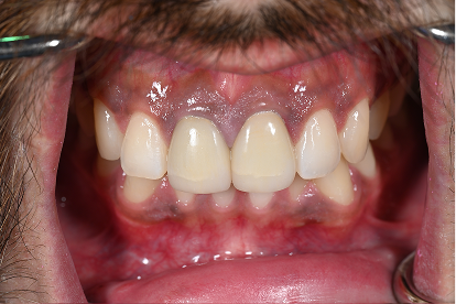Before