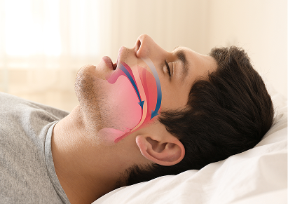 Obstructive Sleep Apnea