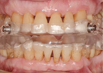 Oral Appliance Therapy